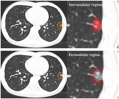 Frontiers | CT-Imaging Based Analysis of Invasive Lung Adenocarcinoma